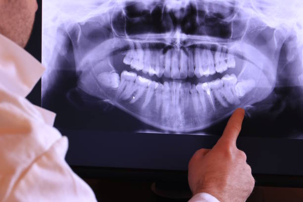 Best Emergency Dental Extractions in Dayton, OH