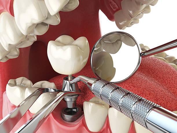 Best Emergency Dentist for Lost Fillings or Crowns in Dayton, OH