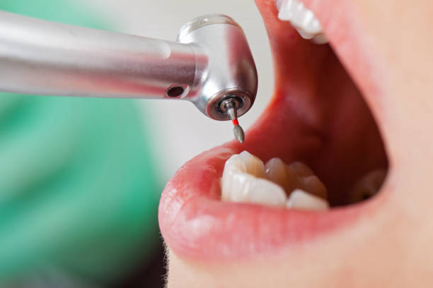 Best Emergency Root Canal Treatment in Dayton, OH